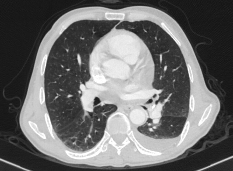 File:Chronic pulmonary embolism with bubbly consolidation (Radiopaedia 91248-108850 Axial lung window 85).jpg