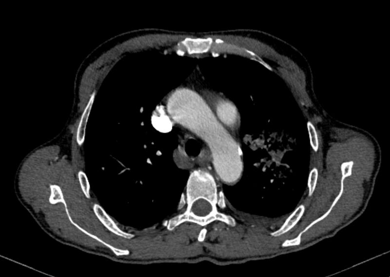 File:Chronic pulmonary embolism with bubbly consolidation (Radiopaedia 91248-108850 C+ arterial phase 41).jpg