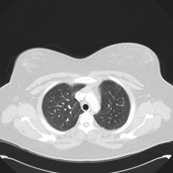 File:Chronic thromboembolic pulmonary hypertension (CTEPH) (Radiopaedia 74597-85531 Axial lung window 14).jpg