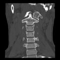 Clay-shoveler fracture (Radiopaedia 22568-22590 Coronal bone window 7).jpg