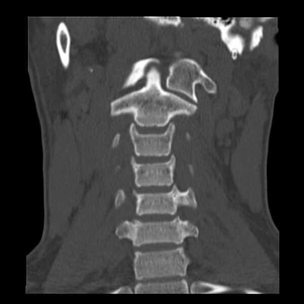File:Clay-shoveler fracture (Radiopaedia 22568-22590 Coronal bone window 7).jpg