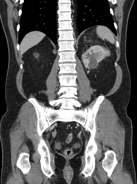 File:Clear cell renal cell carcinoma (Radiopaedia 61449-69393 F 39).jpg