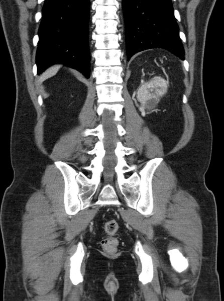 File:Clear cell renal cell carcinoma (Radiopaedia 61449-69393 F 44).jpg