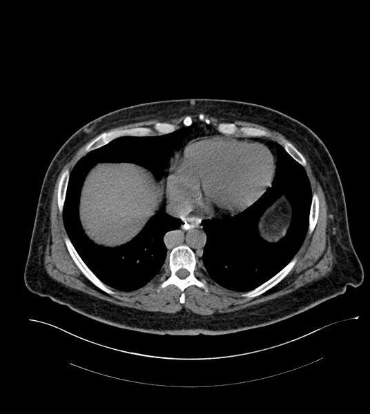 File:Closed-loop small bowel obstruction-internal hernia (Radiopaedia 78439-91096 Axial non-contrast 14).jpg