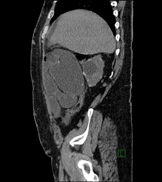 File:Closed-loop small bowel obstruction-internal hernia (Radiopaedia 78439-91096 C 111).jpg