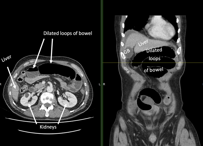 File:Closed loop bowel obstruction and ischemia (Radiopaedia 86959-103635 B 1).png