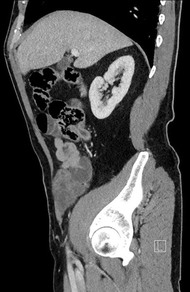 File:Closed loop small bowel obstruction - internal hernia (Radiopaedia 57806-64778 C 80).jpg