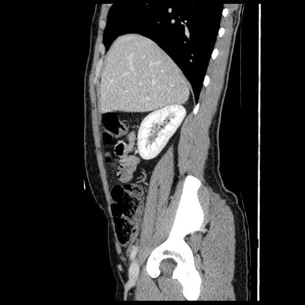 File:Co-existing acute appendicitis and epiploic appendagitis (Radiopaedia 61789-69911 B 26).jpg