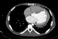 Coarctation of aorta with aortic valve stenosis (Radiopaedia 70463-80574 A 138).jpg