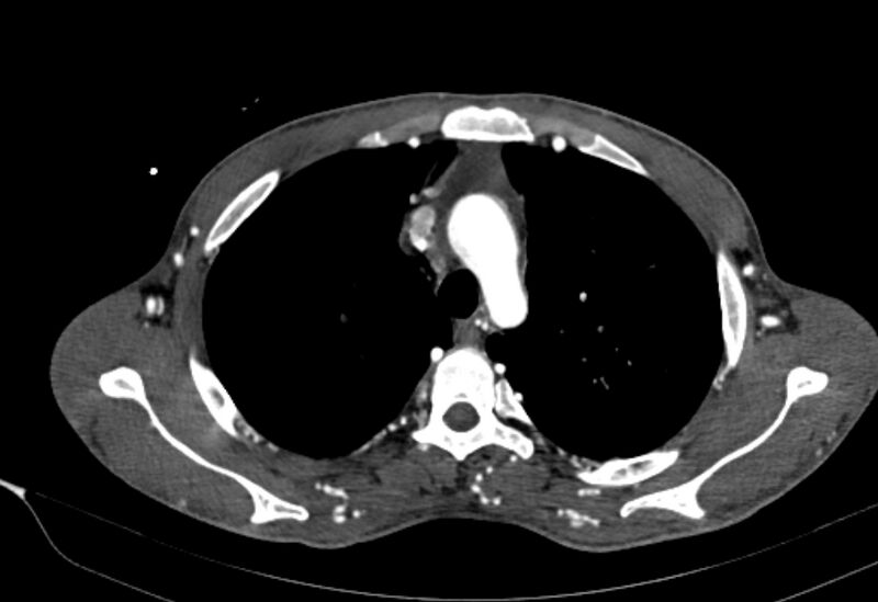 File:Coarctation of aorta with aortic valve stenosis (Radiopaedia 70463-80574 A 32).jpg