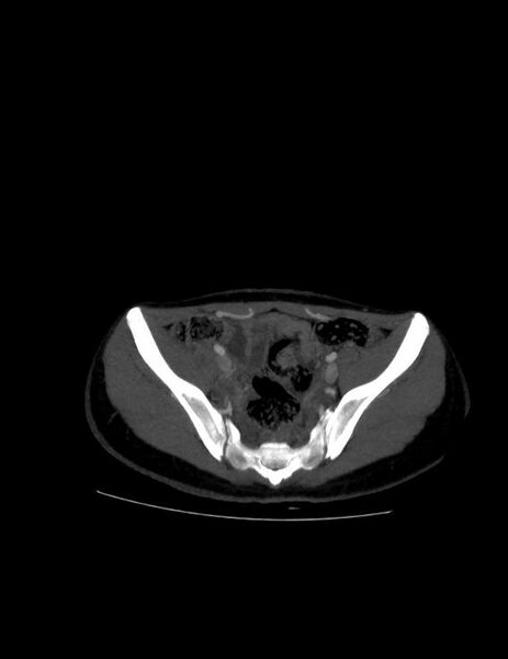 File:Coarctation of the aorta (Radiopaedia 27458-27657 D 44).jpg