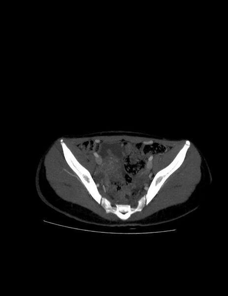 File:Coarctation of the aorta (Radiopaedia 27458-27657 D 45).jpg