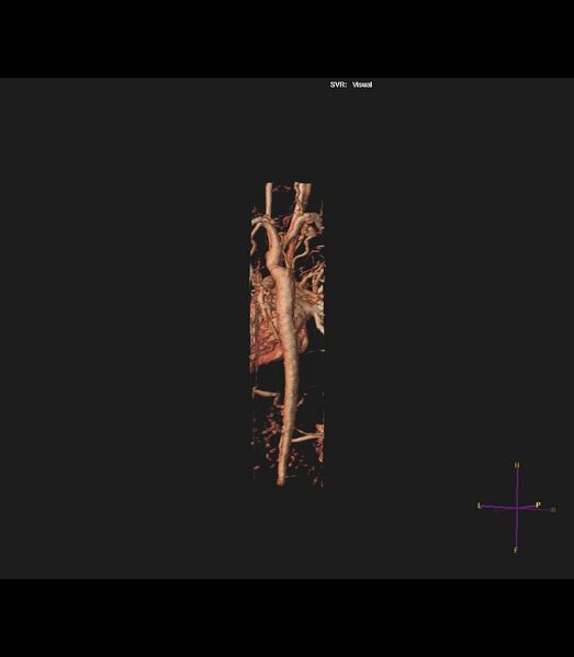 File:Coarctation of the aorta (Radiopaedia 43373-46729 3D reconstruction 9).jpg