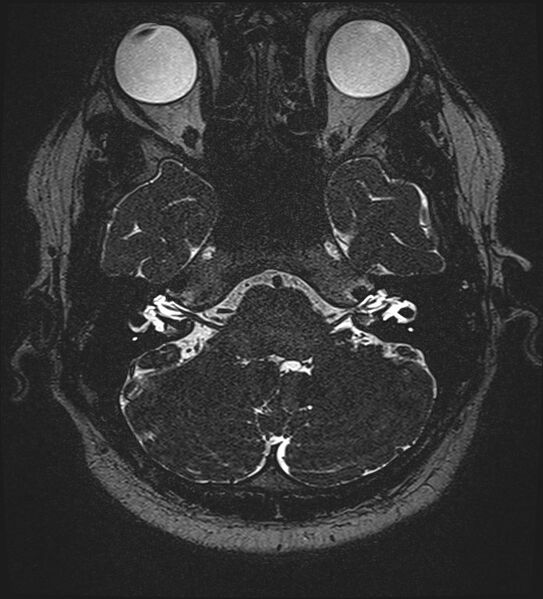 File:Cochlear incomplete partition type III associated with hypothalamic hamartoma (Radiopaedia 88756-105498 Axial T2 68).jpg
