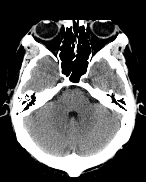 File:Colloid cyst of the third ventricle (Radiopaedia 86571-102661 Axial non-contrast 11).png