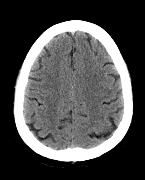 File:Colloid cyst of the third ventricle (Radiopaedia 86571-102661 Axial non-contrast 25).png
