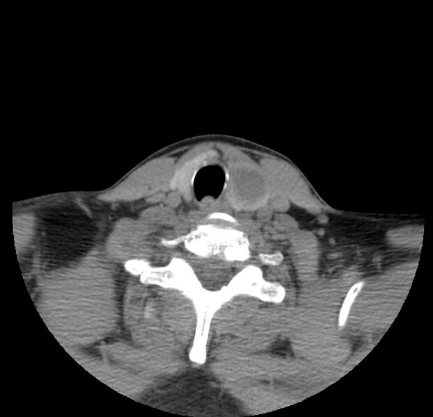 File:Colloid cyst of thyroid (Radiopaedia 22897-22923 Axial non-contrast 41).jpg