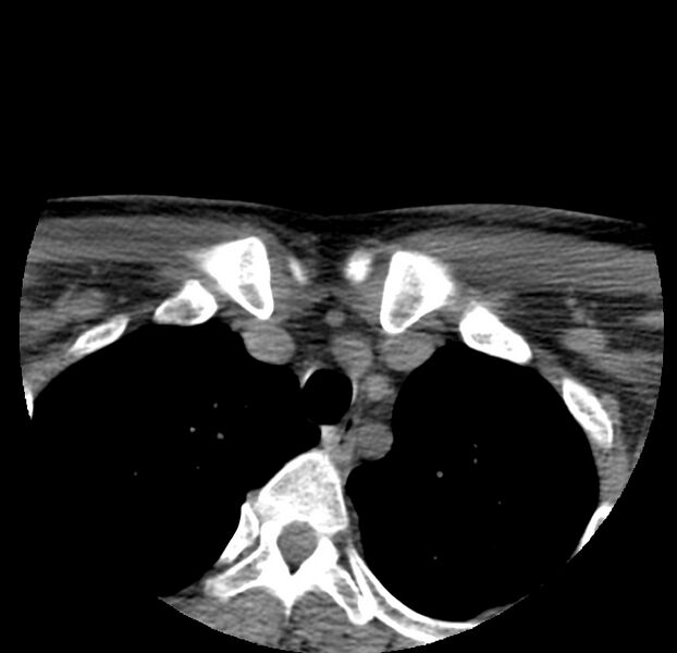 File:Colloid cyst of thyroid (Radiopaedia 22897-22923 Axial non-contrast 56).jpg