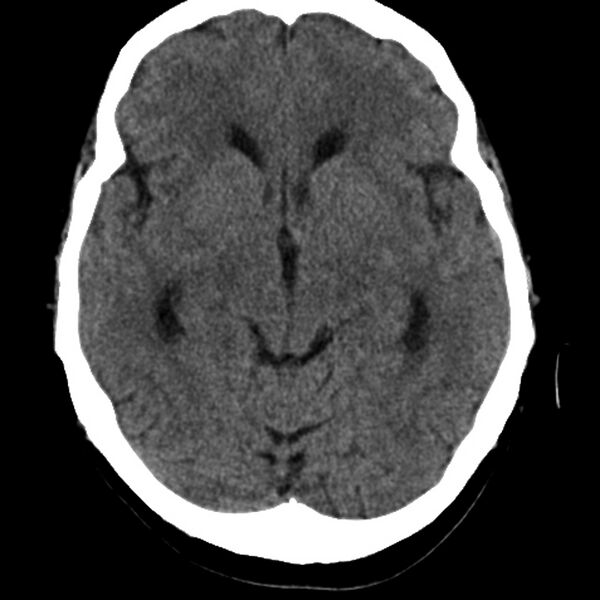 File:Colloid cyst with hydrocephalus (Radiopaedia 9373-10064 Axial non-contrast 9).jpg