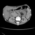 Colocolic fistula - Crohn disease (Radiopaedia 57063-63955 A 26).jpg
