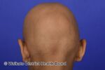 Complete hair loss in alopecia totalis (DermNet NZ diffuse-alopecia-04).jpg
