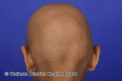 Complete hair loss in alopecia totalis (DermNet NZ diffuse-alopecia-04).jpg