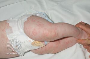 Cryopyrin-associated periodic syndrome rash