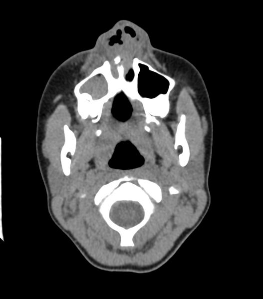 File:Nasoorbitoethmoid fracture (Radiopaedia 90044-107205 Axial non-contrast 102).jpg