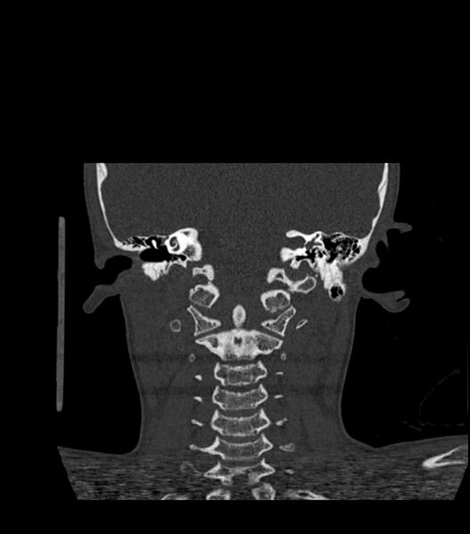 File:Nasoorbitoethmoid fracture (Radiopaedia 90044-107205 Coronal bone window 105).jpg