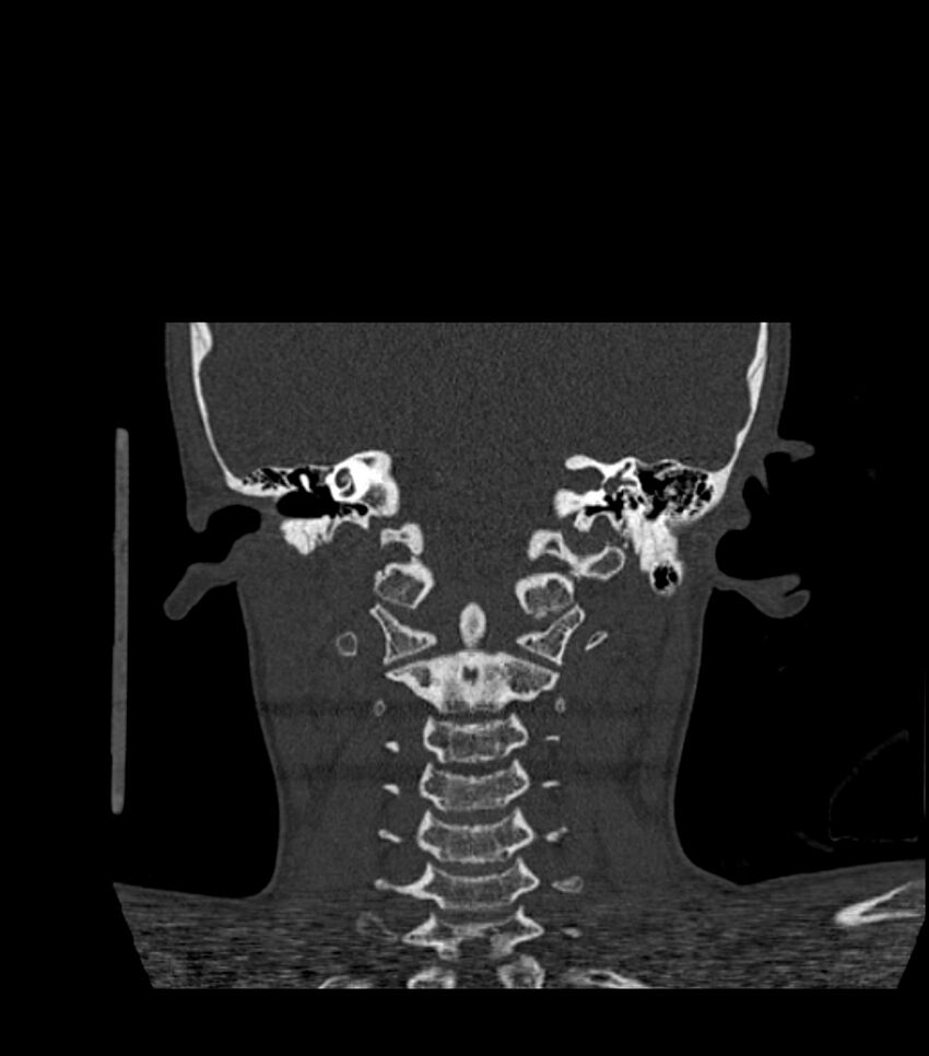 Nasoorbitoethmoid fracture (Radiopaedia 90044-107205 Coronal bone window 105).jpg