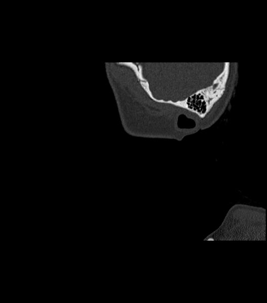File:Nasoorbitoethmoid fracture (Radiopaedia 90044-107205 Sagittal bone window 13).jpg
