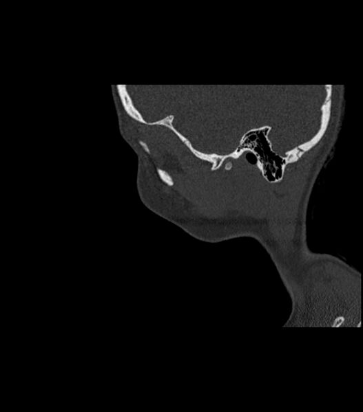 File:Nasoorbitoethmoid fracture (Radiopaedia 90044-107205 Sagittal bone window 25).jpg