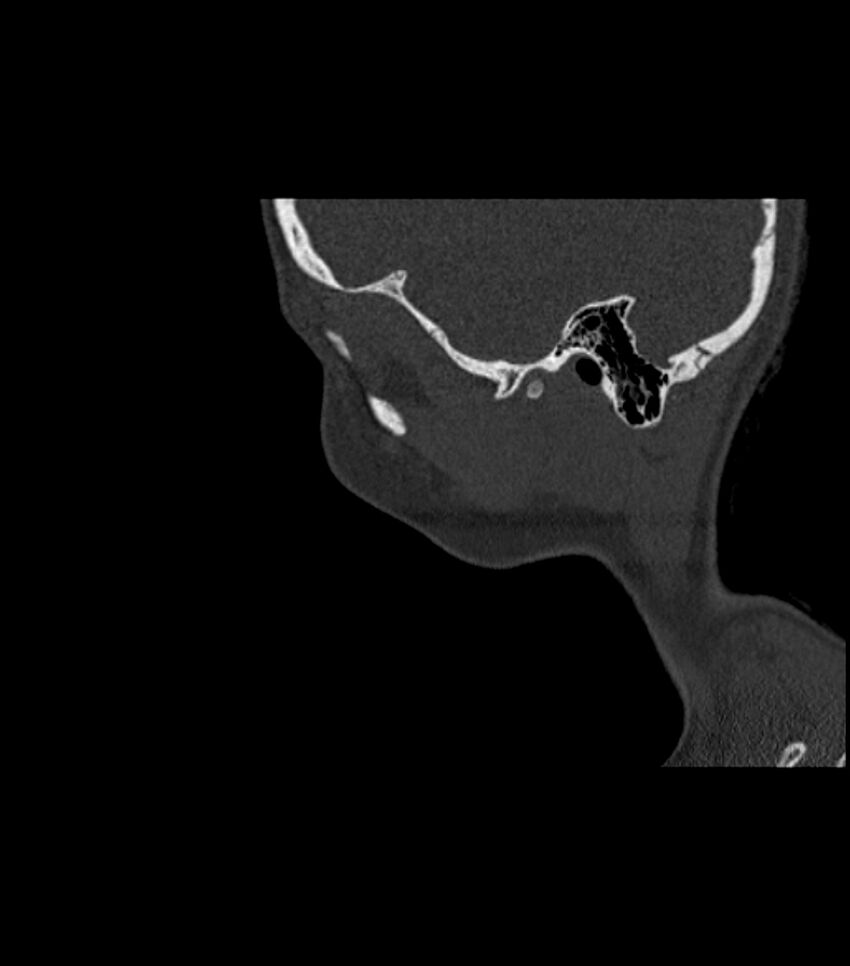 Nasoorbitoethmoid fracture (Radiopaedia 90044-107205 Sagittal bone window 25).jpg