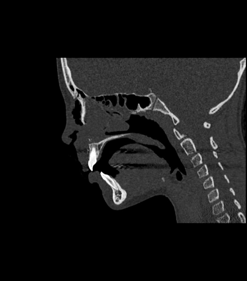 Nasoorbitoethmoid fracture (Radiopaedia 90044-107205 Sagittal bone window 80).jpg