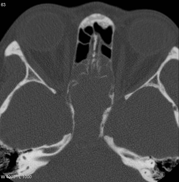 File:Nasopharyngeal carcinoma (recurrent) (Radiopaedia 5061-6903 Axial non-contrast 15).jpg