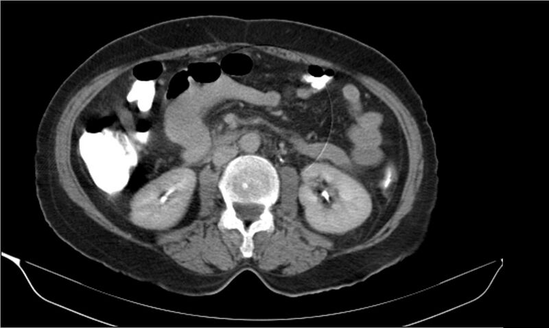 File:Necrotizing pancreatitis (Radiopaedia 20595-20495 Axial C+ delayed 21).jpg