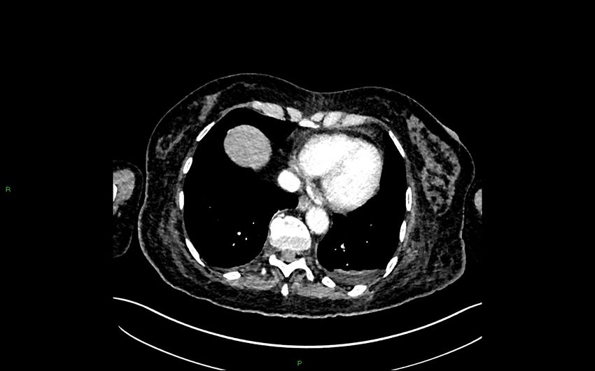 Neo-terminal ileal stricture (Crohn disease) (Radiopaedia 33790-34948 A 12).jpg
