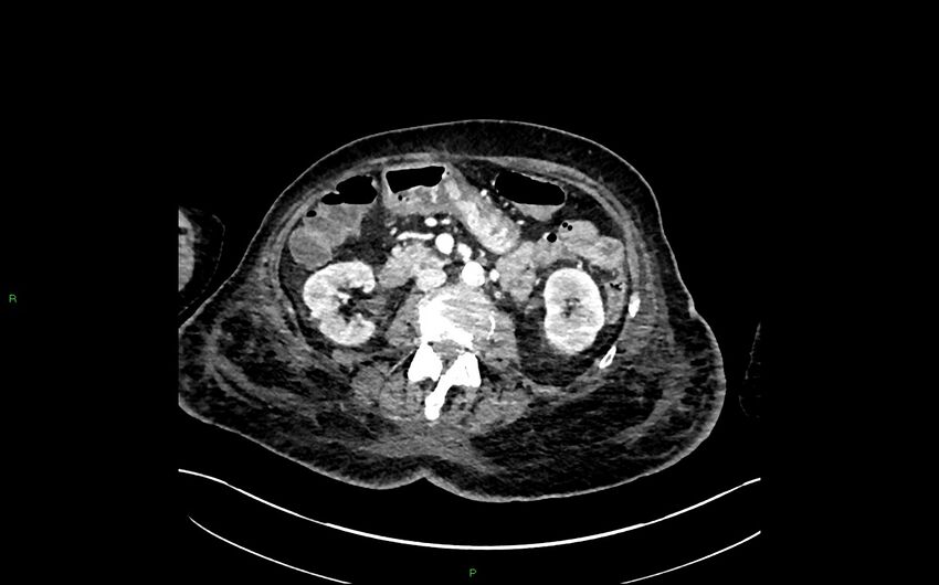Neo-terminal ileal stricture (Crohn disease) (Radiopaedia 33790-34948 A 192).jpg