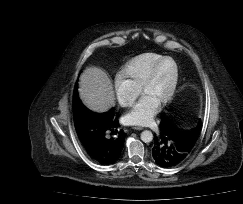 Nephroptosis with inguinal hernia containing perirenal fat (Radiopaedia 56632-63391 C 31).jpg