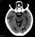 Neurocysticercosis (Radiopaedia 7773-8596 non-contrast 3).jpg
