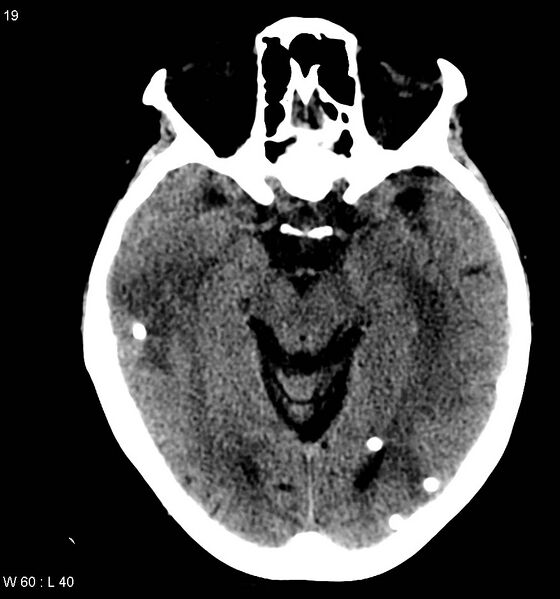 File:Neurocysticercosis (Radiopaedia 7773-8596 non-contrast 3).jpg