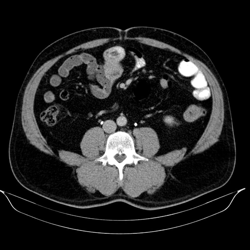 Neuroendocrine tumor of head of pancreas (Radiopaedia 57538-64502 D 49).jpg