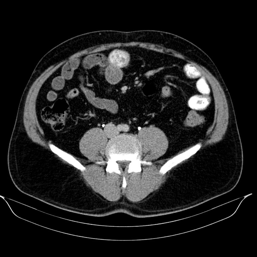 Neuroendocrine tumor of head of pancreas (Radiopaedia 57538-64502 D 53).jpg