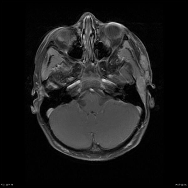 File:Neurofibromatosis type 1 (Radiopaedia 22541-22564 Axial T1 C+ fat sat 20).jpg