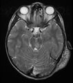 Neurofibromatosis type 1 (Radiopaedia 6954-8063 Axial T2 5).jpg