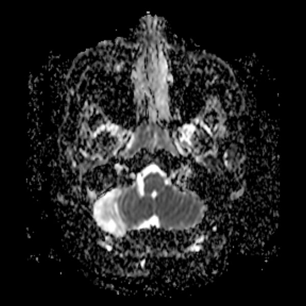 File:Neurofibromatosis type 2 (Radiopaedia 67470-76871 Axial ADC 3).jpg