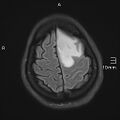 Neurotoxoplasmosis - concentric target sign (Radiopaedia 70644-80784 Axial FLAIR 18).jpg