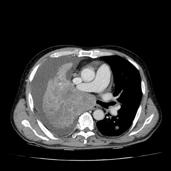 File:Non small-cell lung cancer (Radiopaedia 24467-24769 C+ delayed 29).jpg