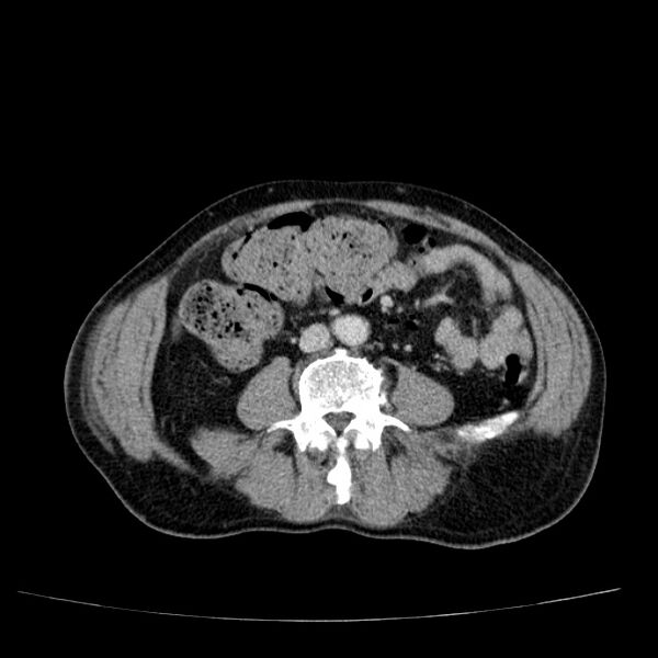 File:Non small-cell lung cancer (Radiopaedia 24467-24769 C+ delayed 84).jpg