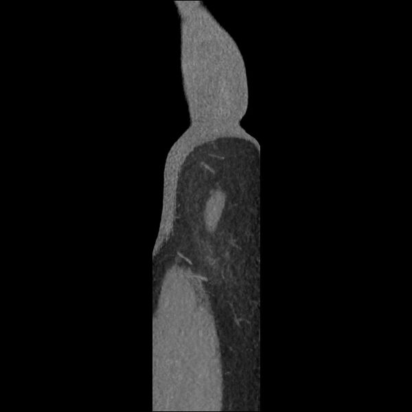 File:Normal CT angiogram of pelvis (Radiopaedia 45390-49430 C 2).jpg